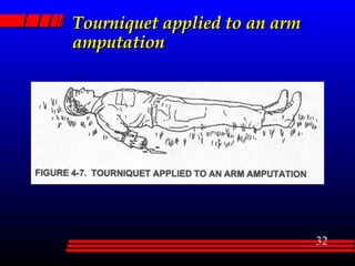 Tourniquet applied to an arm amputation 