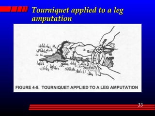 Tourniquet applied to a leg amputation 