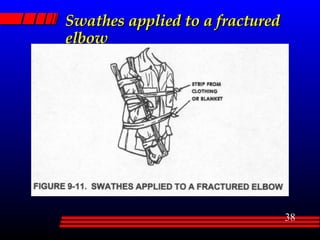 Swathes applied to a fractured elbow 