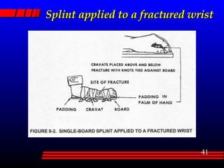 Splint applied to a fractured wrist 