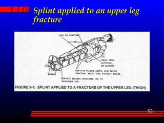 Splint applied to an upper leg fracture 