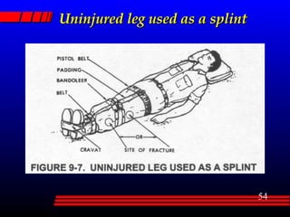 Uninjured leg used as a splint 