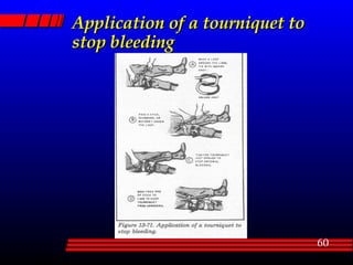 Application of a tourniquet to stop bleeding 