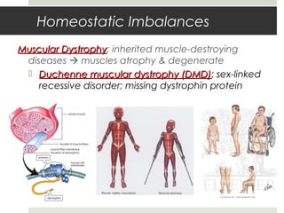 Homeostatic Imbalances
Muscular DystrophyMuscular Dystrophy: inherited muscle-destroying
diseases  muscles atrophy & degenerate
 Duchenne muscular dystrophy (DMD)Duchenne muscular dystrophy (DMD): sex-linked
recessive disorder; missing dystrophin protein
 