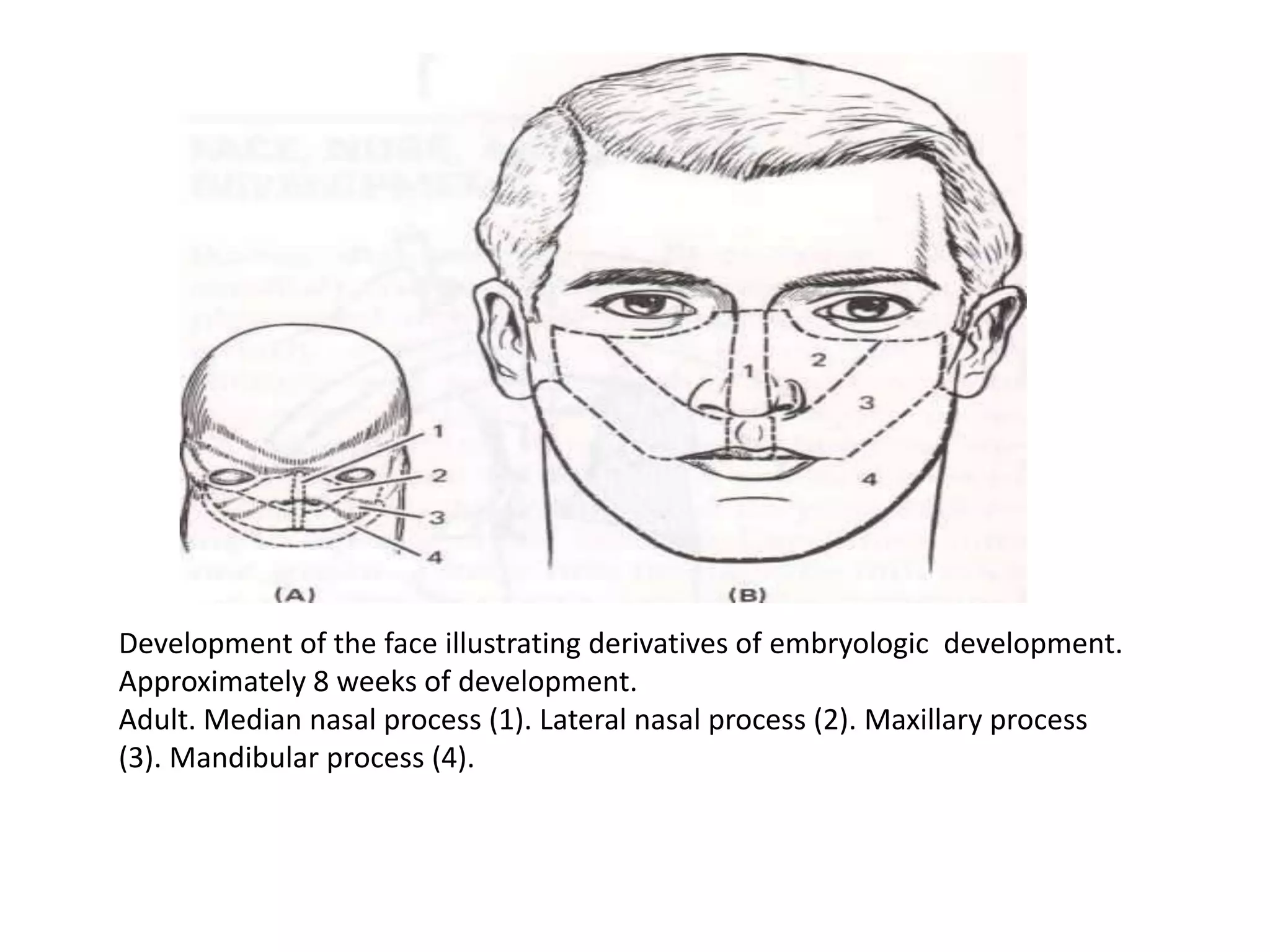 Development of the face illustrating derivatives of embryologic development.
Approximately 8 weeks of development.
Adult. Median nasal process (1). Lateral nasal process (2). Maxillary process
(3). Mandibular process (4).
 