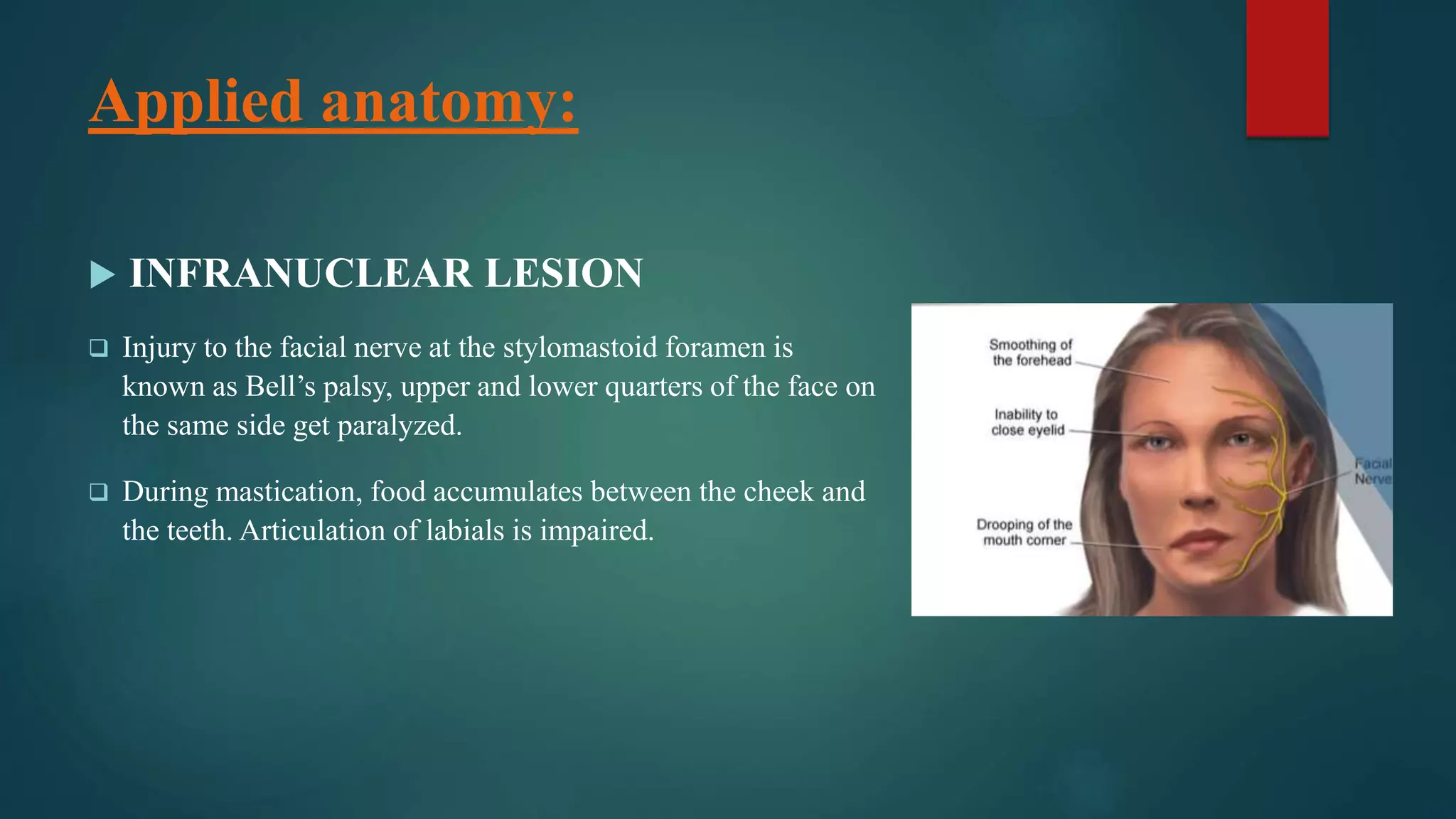 Applied anatomy:
 INFRANUCLEAR LESION
 Injury to the facial nerve at the stylomastoid foramen is
known as Bell’s palsy, upper and lower quarters of the face on
the same side get paralyzed.
 During mastication, food accumulates between the cheek and
the teeth. Articulation of labials is impaired.
 