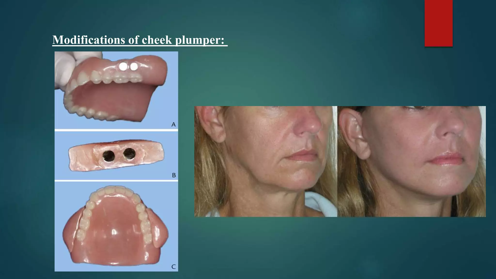 Modifications of cheek plumper:
 