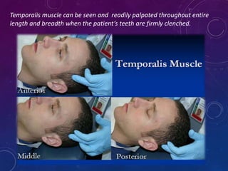 Temporalis muscle can be seen and readily palpated throughout entire
length and breadth when the patient’s teeth are firmly clenched.
 