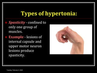 Types of hypertonia:
 Spasticity - confined to
only one group of
muscles.
 Example - lesions of
internal capsule and
upper motor neuron
lesions produce
spasticity.
Tuesday, February 4, 2020
 
