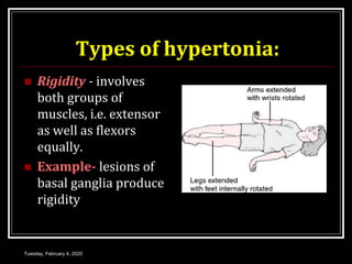 Types of hypertonia:
 Rigidity - involves
both groups of
muscles, i.e. extensor
as well as flexors
equally.
 Example- lesions of
basal ganglia produce
rigidity
Tuesday, February 4, 2020
 