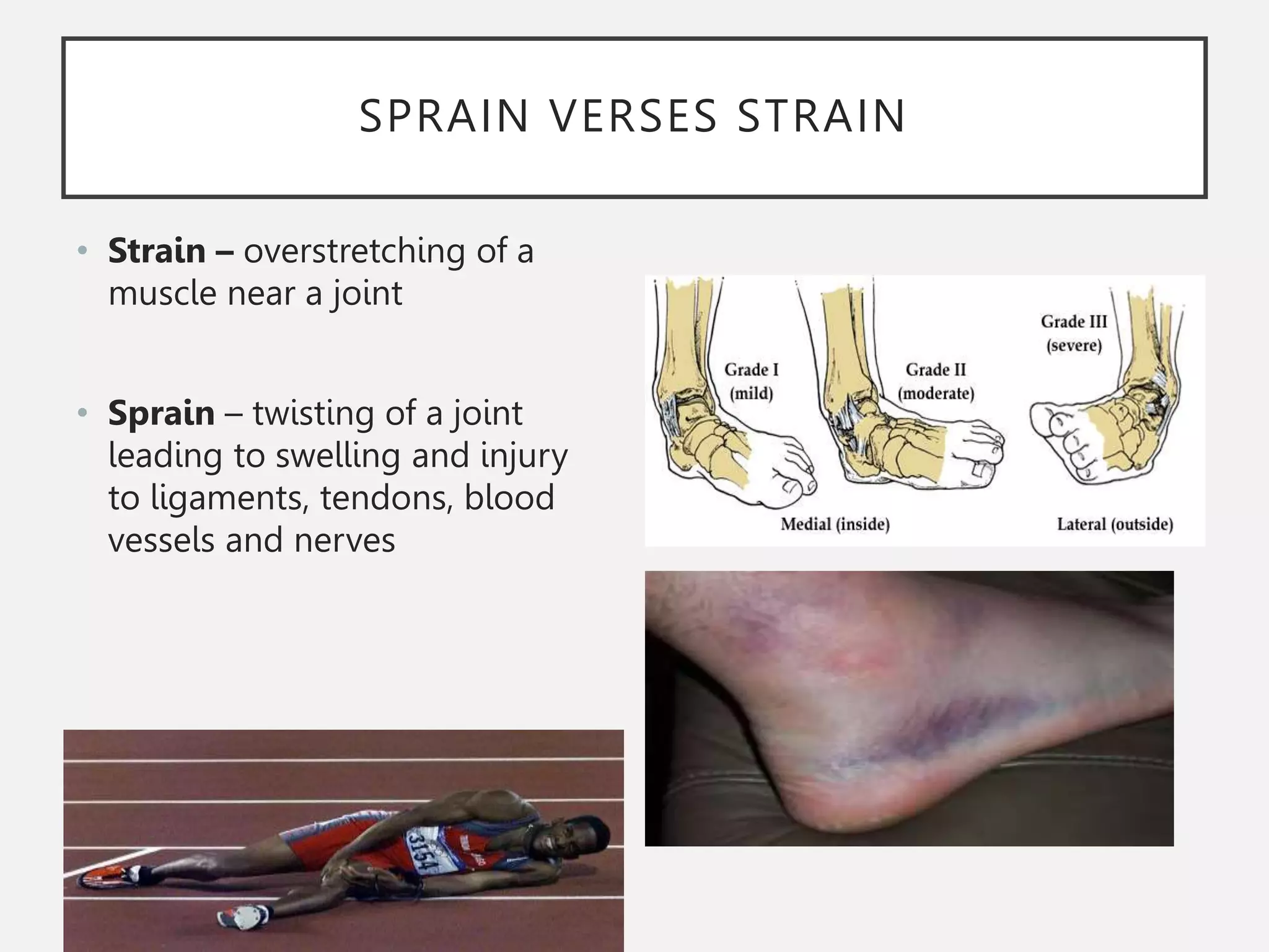 SPRAIN VERSES STRAIN
• Strain – overstretching of a
muscle near a joint
• Sprain – twisting of a joint
leading to swelling and injury
to ligaments, tendons, blood
vessels and nerves
 