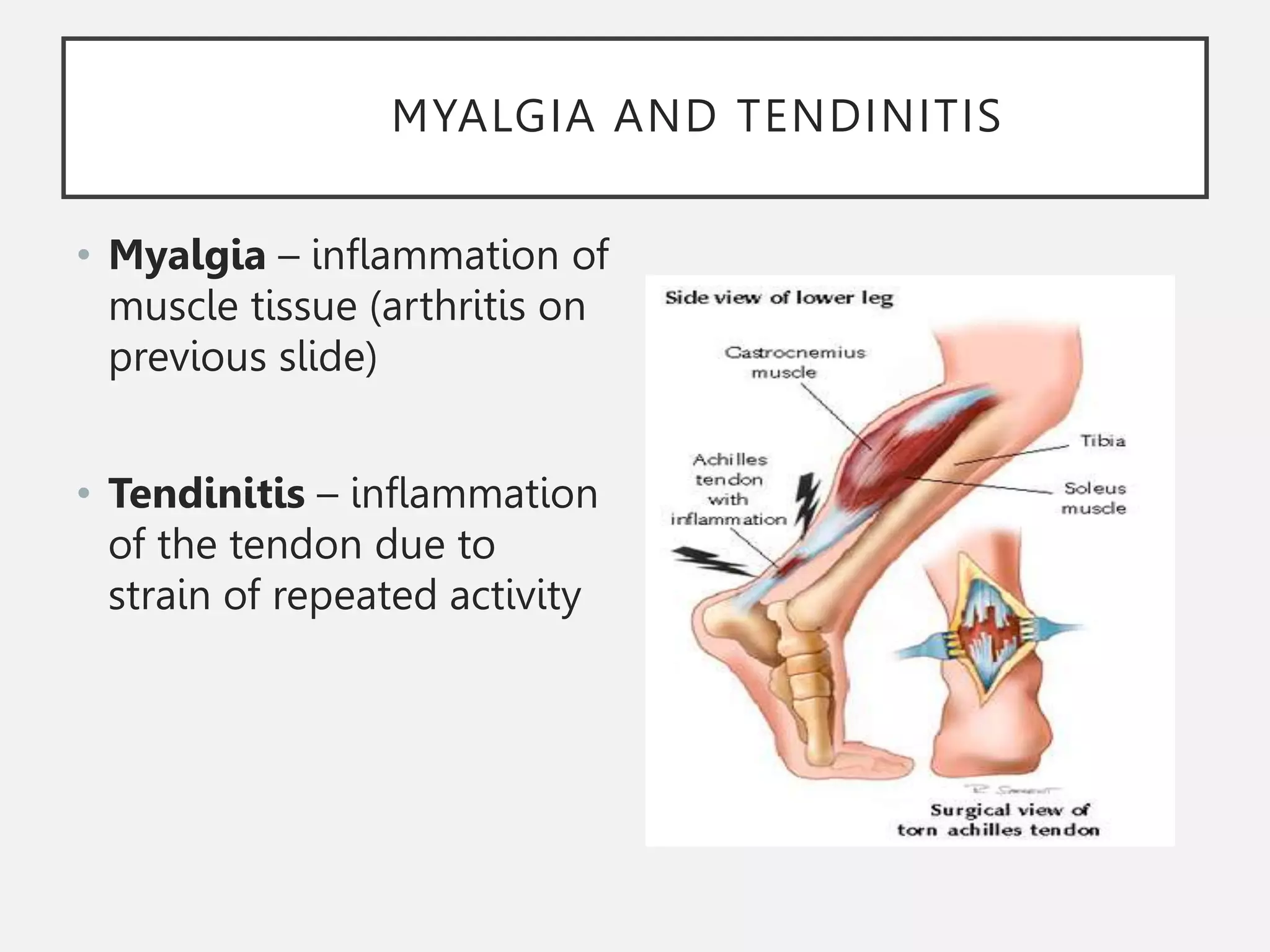 MYALGIA AND TENDINITIS
• Myalgia – inflammation of
muscle tissue (arthritis on
previous slide)
• Tendinitis – inflammation
of the tendon due to
strain of repeated activity
 