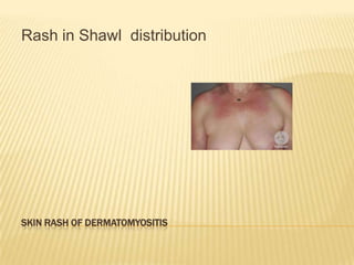 Rash in Shawl distribution




SKIN RASH OF DERMATOMYOSITIS
 