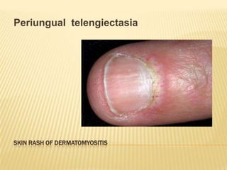 Periungual telengiectasia




SKIN RASH OF DERMATOMYOSITIS
 