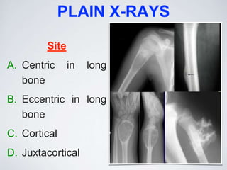 PLAIN X-RAYS
Site
A. Centric in long
bone
B. Eccentric in long
bone
C. Cortical
D. Juxtacortical
 