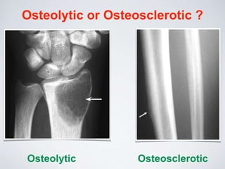 Osteolytic or Osteosclerotic ?
Osteolytic Osteosclerotic
 