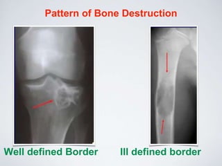 Pattern of Bone Destruction
Well defined Border Ill defined border
 