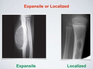 Expansile or Localized
Expansile Localized
 