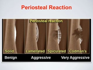 Periosteal Reaction
 