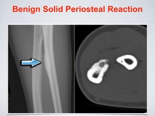 Benign Solid Periosteal Reaction
 