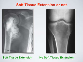 Soft Tissue Extension or not
Soft Tissue Extension No Soft Tissue Extension
 