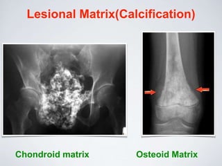 Lesional Matrix(Calcification)
Chondroid matrix Osteoid Matrix
 
