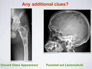 Any additional clues?
Ground Glass Appearance Punched out Lesion(skull)
 