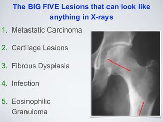 The BIG FIVE Lesions that can look like
anything in X-rays
1. Metastatic Carcinoma
2. Cartilage Lesions
3. Fibrous Dysplasia
4. Infection
5. Eosinophilic
Granuloma
 