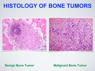 HISTOLOGY OF BONE TUMORS
Benign Bone Tumor Malignant Bone Tumor
 