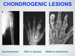 CHONDROGENIC LESIONS
Enchondroma Ollier’s disease Maffucci Syndrome
 