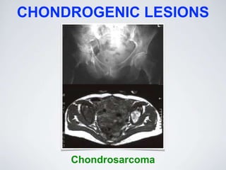 CHONDROGENIC LESIONS
Chondrosarcoma
 