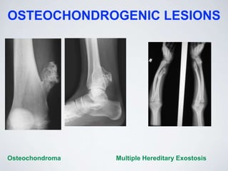 OSTEOCHONDROGENIC LESIONS
Osteochondroma Multiple Hereditary Exostosis
 