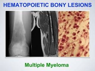 HEMATOPOIETIC BONY LESIONS
Multiple Myeloma
 
