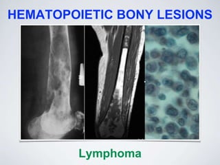 HEMATOPOIETIC BONY LESIONS
Lymphoma
 
