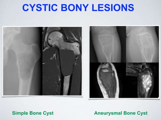 CYSTIC BONY LESIONS
Simple Bone Cyst Aneurysmal Bone Cyst
 