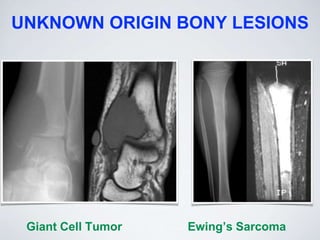 UNKNOWN ORIGIN BONY LESIONS
Giant Cell Tumor Ewing’s Sarcoma
 