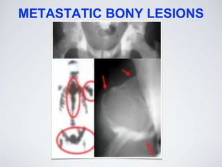 METASTATIC BONY LESIONS
 