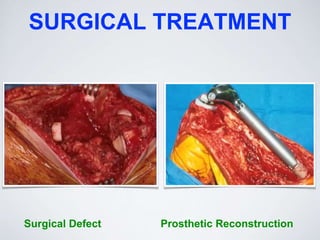 SURGICAL TREATMENT
Surgical Defect Prosthetic Reconstruction
 
