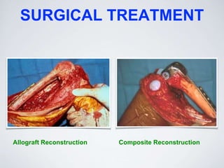 SURGICAL TREATMENT
Allograft Reconstruction Composite Reconstruction
 