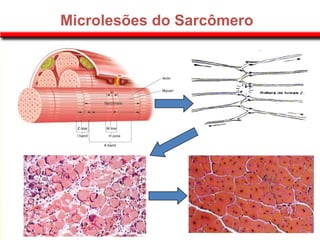 Microlesões do Sarcômero
 