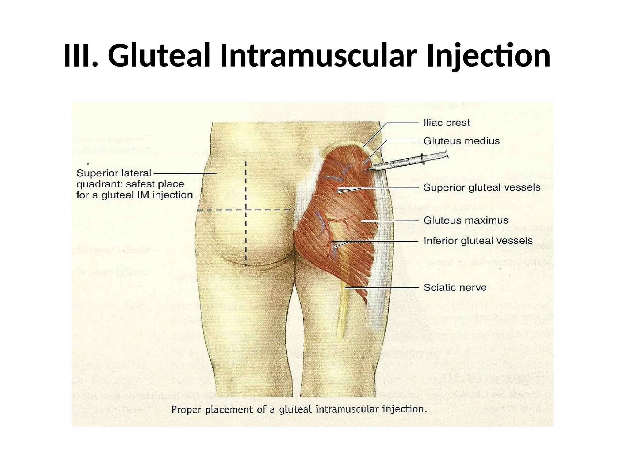 III. Gluteal Intramuscular Injection
 