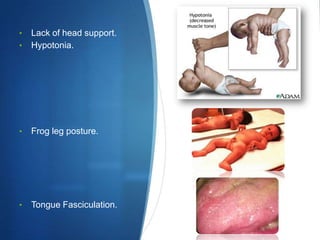 •   Lack of head support.
•   Hypotonia.




•   Frog leg posture.




•   Tongue Fasciculation.
 