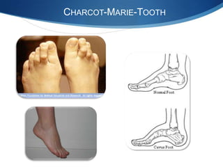 CHARCOT-MARIE-TOOTH
 