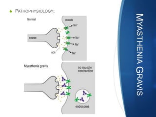 S PATHOPHYSIOLOGY;




                     MYASTHENIA GRAVIS
 