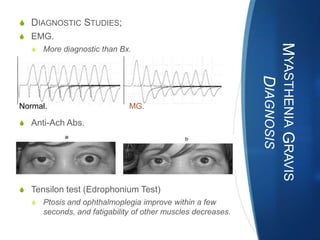 S DIAGNOSTIC STUDIES;
S EMG.




                                                              MYASTHENIA GRAVIS
   S More diagnostic than Bx.




                                                                 DIAGNOSIS
Normal.                       MG.

S Anti-Ach Abs.




S Tensilon test (Edrophonium Test)
   S Ptosis and ophthalmoplegia improve within a few
      seconds, and fatigability of other muscles decreases.
 