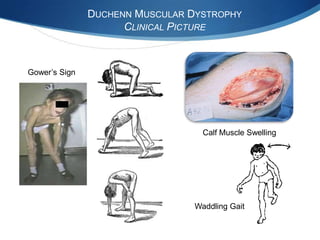 DUCHENN MUSCULAR DYSTROPHY
                     CLINICAL PICTURE



Gower’s Sign




                                   Calf Muscle Swelling




                                 Waddling Gait
 