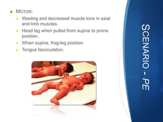 S MOTOR:
  S Wasting and decreased muscle tone in axial
    and limb muscles.




                                                 SCENARIO - PE
  S Head lag when pulled from supine to prone
    position.
  S When supine, frog-leg position.
  S Tongue fasciculation.
 