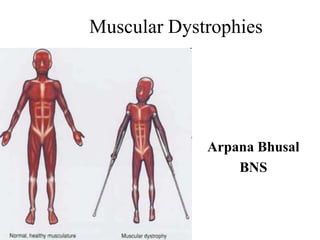 Muscular Dystrophies
Arpana Bhusal
BNS
 