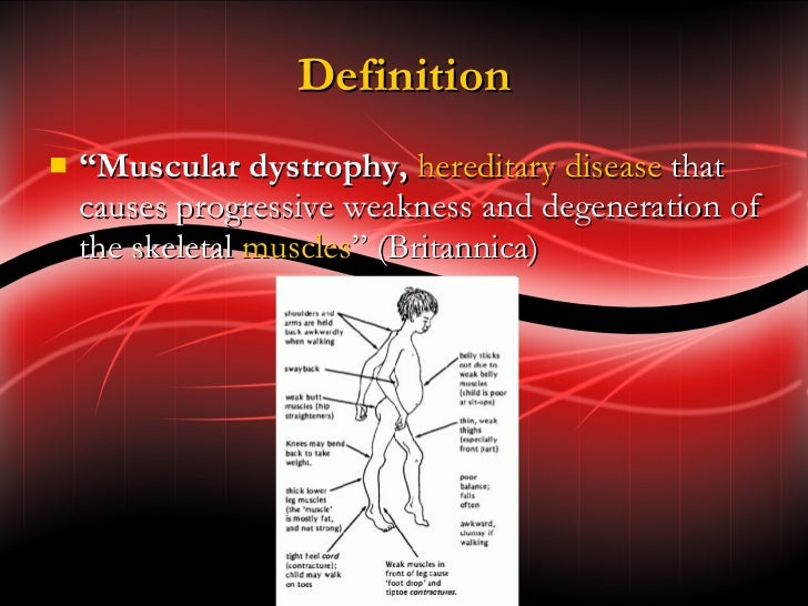 Muscular dystrophy