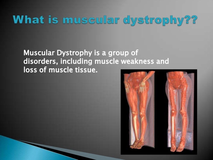 Muscular dystrophy